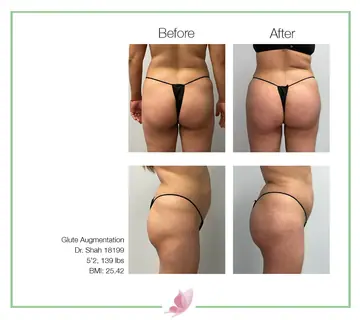 Before and after: Buttock Augmentations, Dr. Darshan R. Shah