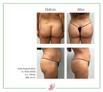 Before and after: Buttock Augmentations, Dr. Darshan R. Shah