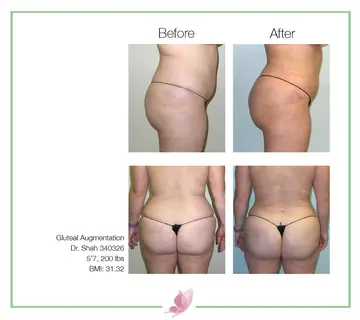 Before and after: Buttock Augmentations, Dr. Darshan R. Shah