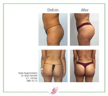 Before and after: Buttock Augmentations, Dr. Darshan R. Shah