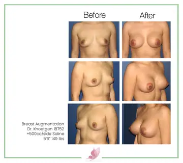 Before and after: Breast Augmentation, Dr. James Knoetgen