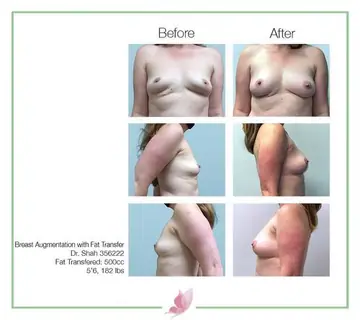Before and after: Breast Augmentation With Fat Transfer, Dr. Darshan R. Shah