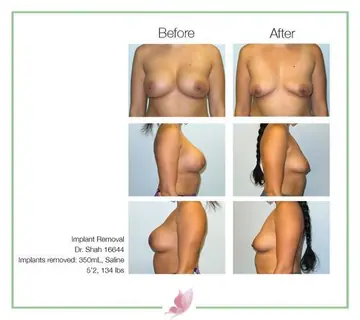 Before and after: Implant Removal, Dr. Darshan R. Shah