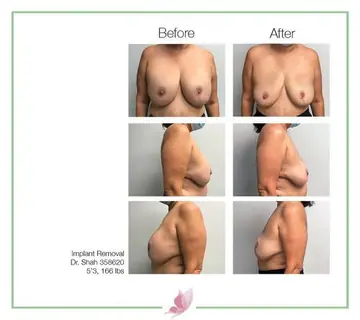 Before and after: Implant Removal, Dr. Darshan R. Shah