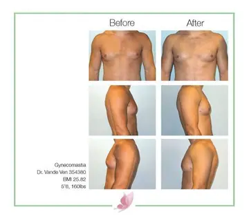Before and after: Gynecomastia, Dr. Heather Vande Ven