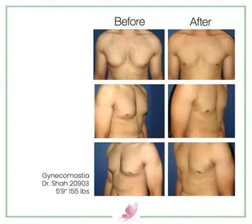 Before and after: Gynecomastia, Dr. Darshan R. Shah