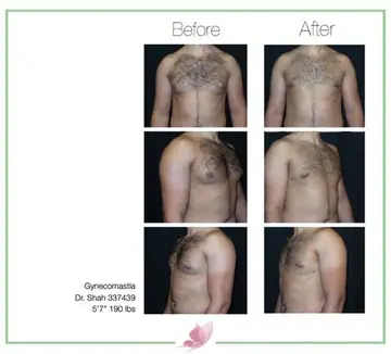 Before and after: Gynecomastia, Dr. Darshan R. Shah