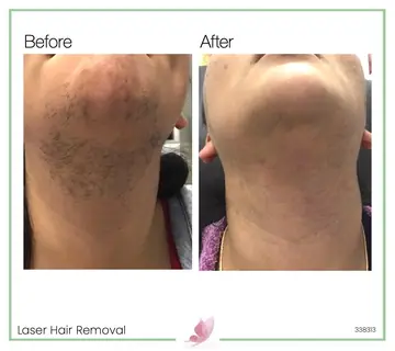 Before and after: Laser Hair Removal