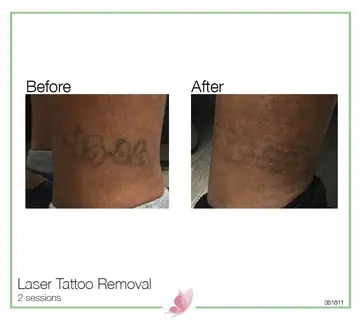 Before and after: Laser Tattoo Removal
