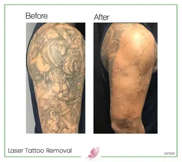 Before and after: Laser Tattoo Removal