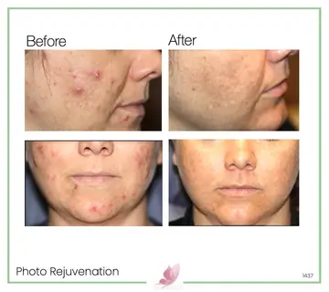 Before and after: Photo Rejuvenation With Levulan