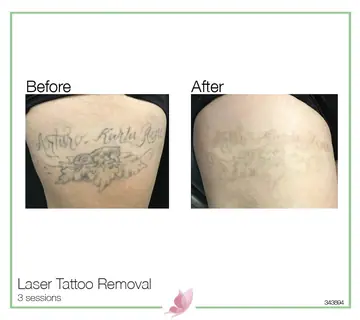 Before and after: Laser Tattoo Removal