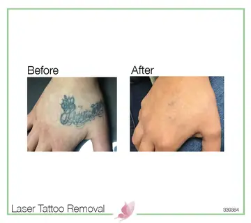 Before and after: Laser Tattoo Removal