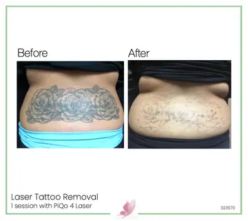 Before and after: Laser Tattoo Removal