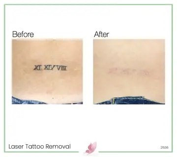 Before and after: Laser Tattoo Removal