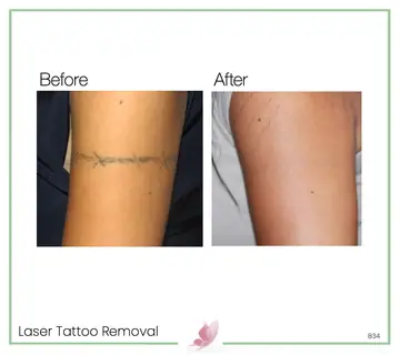 Before and after: Laser Tattoo Removal