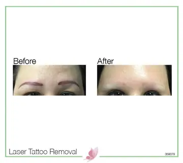 Before and after: Laser Tattoo Removal
