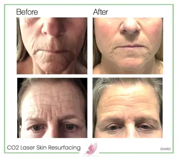 Before and after: Co2 Laser Skin Resurfacing