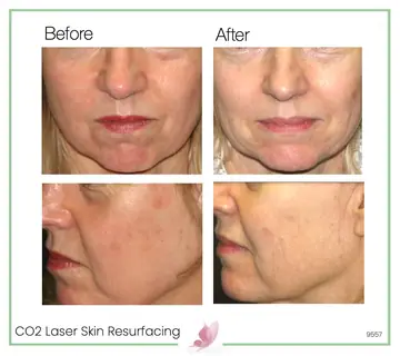 Before and after: Co2 Laser Skin Resurfacing