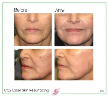 Before and after: Co2 Laser Skin Resurfacing