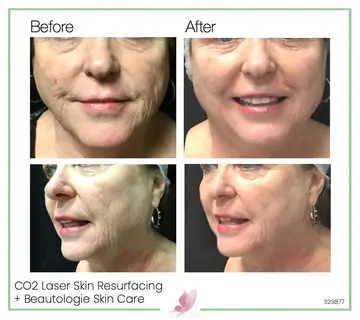 Before and after: Co2 Laser Skin Resurfacing
