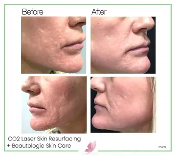 Before and after: Co2 Laser Skin Resurfacing