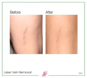 Before and after: Laser Vein Treatment