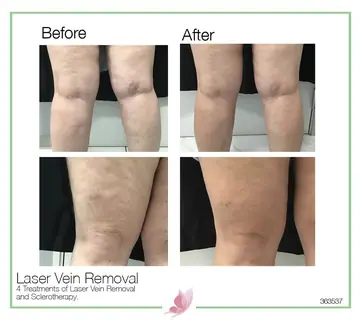 Before and after: Laser Vein Treatment
