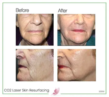 Before and after: Co2 Laser Skin Resurfacing