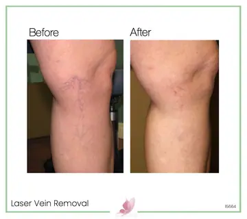 Before and after: Laser Vein Treatment