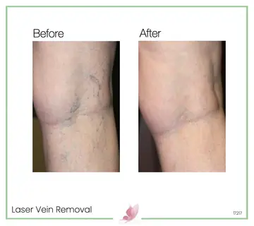 Before and after: Laser Vein Treatment