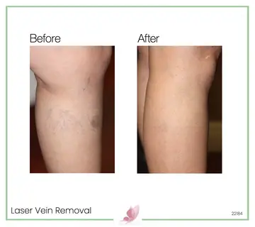 Before and after: Laser Vein Treatment