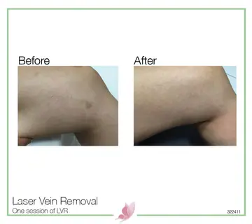 Before and after: Laser Vein Treatment