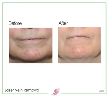 Before and after: Laser Vein Treatment