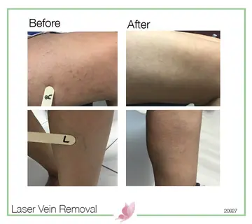Before and after: Laser Vein Treatment