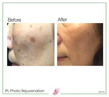 Before and after: Ipl Photo Rejuvenation