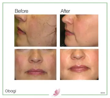 Before and after: Obagi