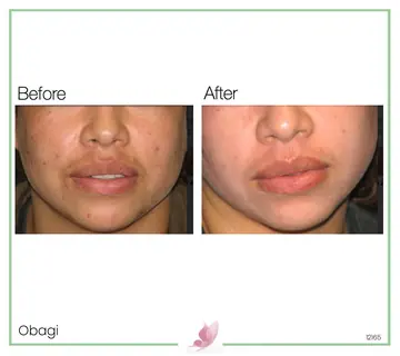 Before and after: Obagi
