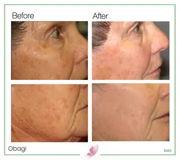 Before and after: Obagi