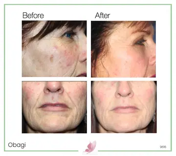 Before and after: Obagi