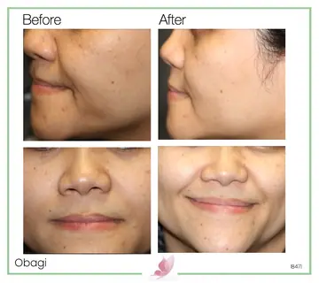 Before and after: Obagi