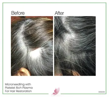 Before and after: Micro Needling With Prp