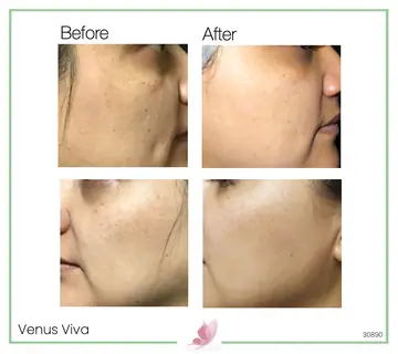Before and after: Venus Viva