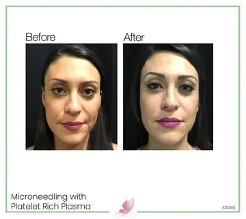Before and after: Micro Needling With Prp