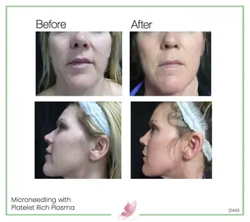 Before and after: Micro Needling With Prp