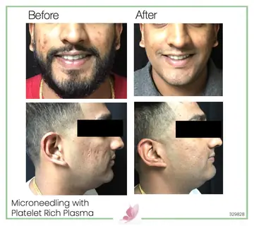 Before and after: Micro Needling With Prp
