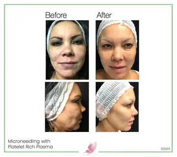 Before and after: Micro Needling With Prp