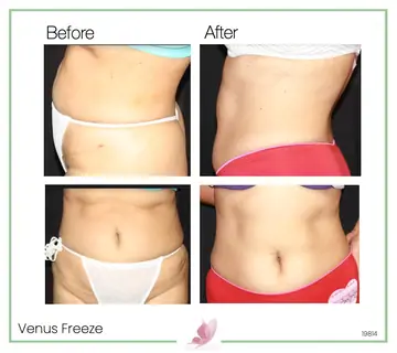 Before and after: Venus Freeze