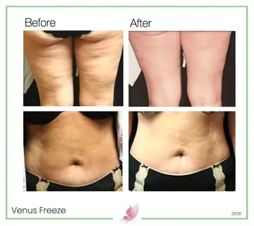 Before and after: Venus Freeze