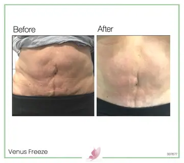 Before and after: Venus Freeze